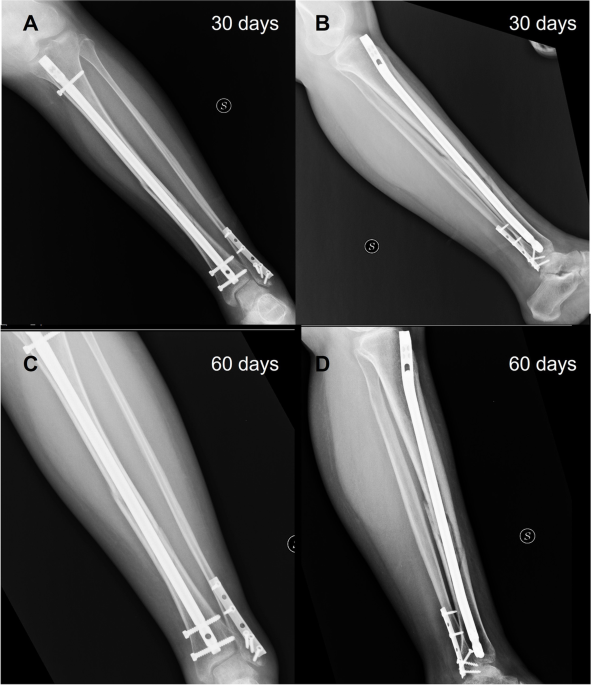 Fixation of a Distal Diaphyseal Tibia Fracture with Neurovascular Tissue  Incarceration: Surgical Technique Using a Lesser Invasive Approach