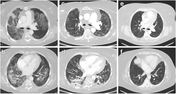 glutathione pneumonia The Role of Reductase in Influenza Infection A Targeted Metabolomic Assessment of