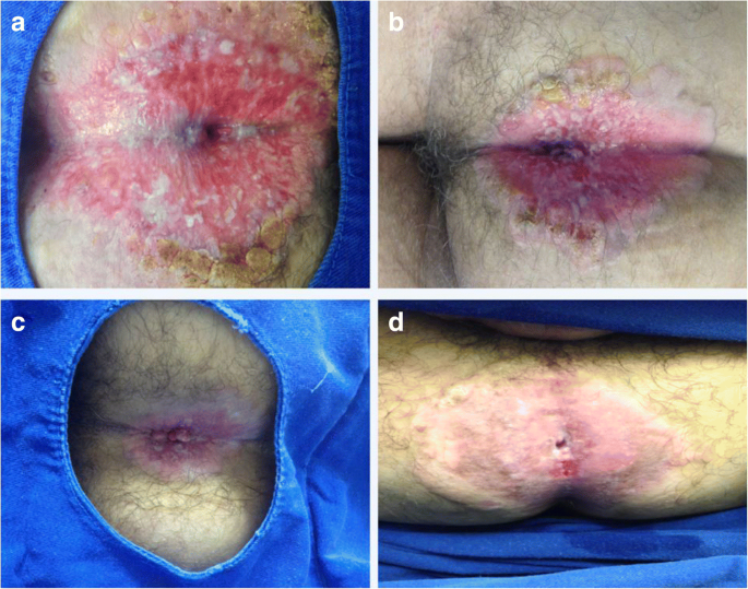 Rare perianal extramammary Paget disease successfully treated using topical  Imiquimod therapy | BMC Cancer | Full Text