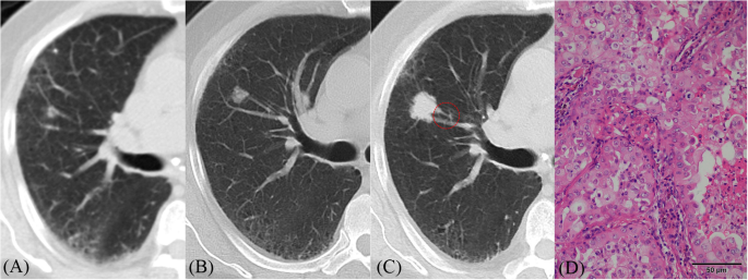 Primary solid lung cancerous nodules with different sizes: computed  tomography features and their variations | BMC Cancer | Full Text