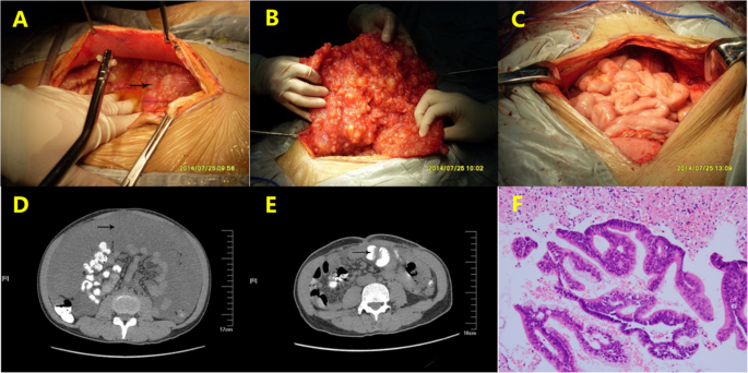 Endoscopic surveillance with systematic random biopsy for the early  diagnosis of hereditary diffuse gastric cancer: a prospectiv