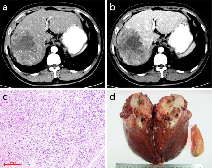 melanotic sarcoma liver Clinical and imaging characteristics of primary hepatic sarcomatoid  carcinoma and sarcoma: a comparative study | BMC Cancer