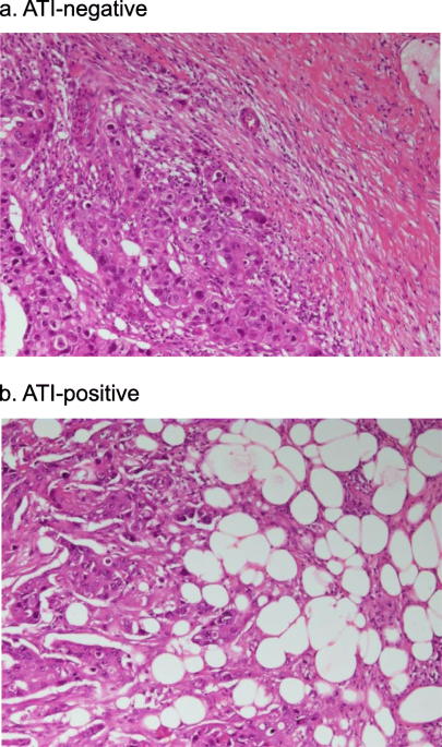Active behavior of triple-negative breast cancer with adipose tissue  invasion: a single center and retrospective review, BMC Cancer
