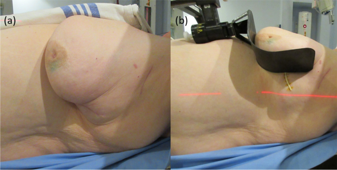 Pendulous breast in supine position without microshell