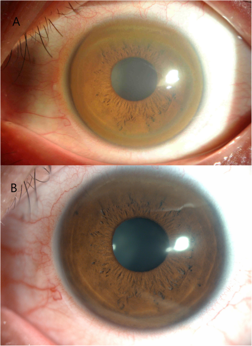 Kayser–Fleischer ring with keratoconus: a coincidence? A case report | BMC  Ophthalmology | Full Text