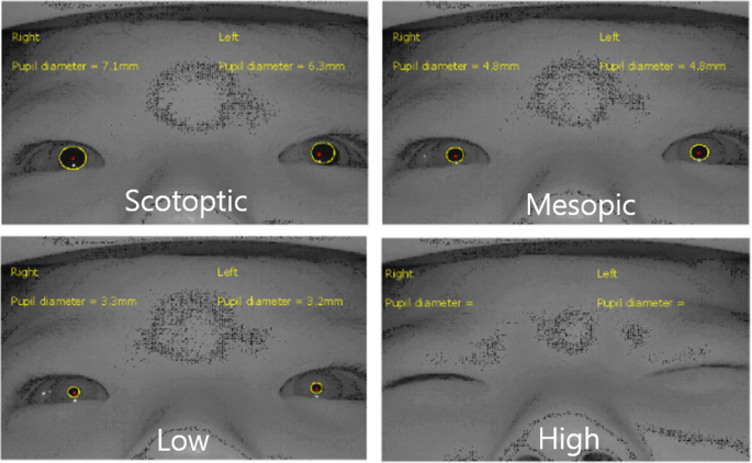 Investigation of transient eye closure evoked with bright light in the  patients with intermittent exotropia, BMC Ophthalmology