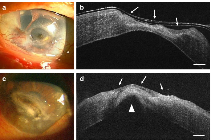 Bilateral corneal perforation caused by neurotrophic keratopathy associated with leprosy: a case report | BMC Ophthalmology