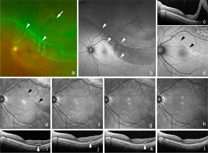Retinal Detachment - Robson Eye Institute