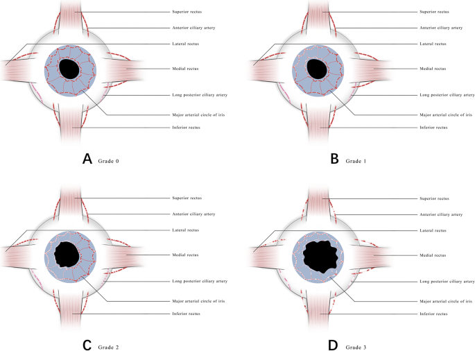 A novel predictive model for phthisis bulbi following facial hyaluronic  acid cosmetic injection | BMC Ophthalmology | Full Text