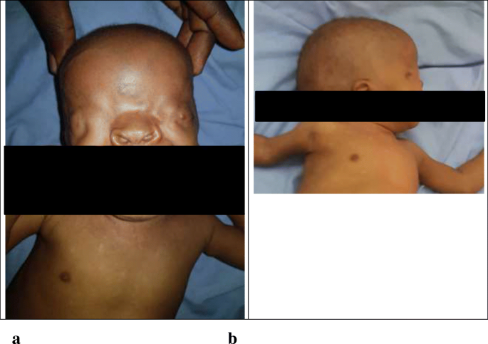 Diagnosis of Fraser syndrome missed out until the age of six months old in  a low-resource setting: a case report | BMC Pediatrics | Full Text