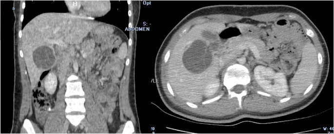 Intraperitoneal rupture of the hydatid cyst: Four case reports and  literature review