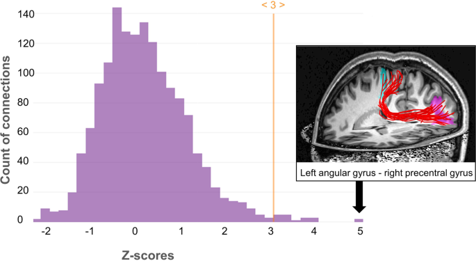 Synaesthesia: Man born blind feels numbers and dates as textures