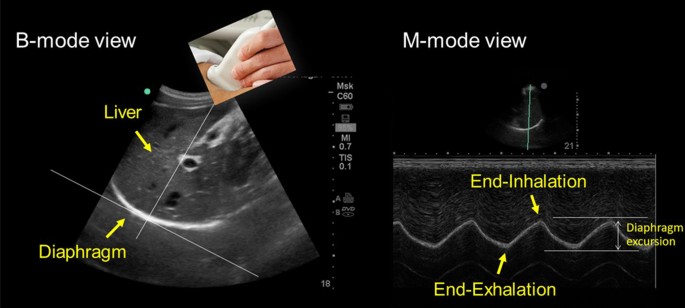 Ultrasound and non-ultrasound imaging techniques in the assessment of  diaphragmatic dysfunction, BMC Pulmonary Medicine