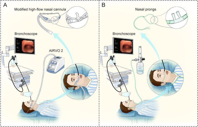 Modified high-flow nasal cannula oxygen therapy versus conventional oxygen  therapy in patients undergoing bronchoscopy: a randomized clinical trial |  BMC Pulmonary Medicine | Full Text