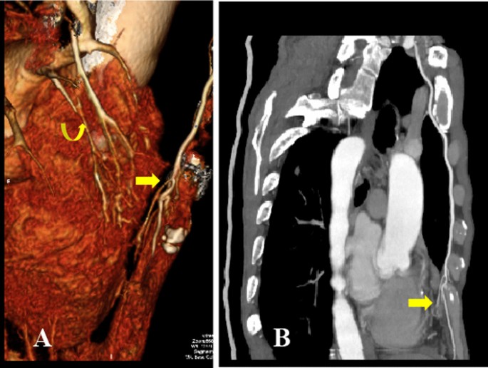 Braz J Cardiovasc Surg - The pulmonary vascular blood supply in