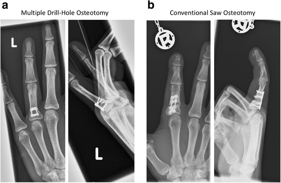 Long-term results following osteotomy of the thumb delta phalanx