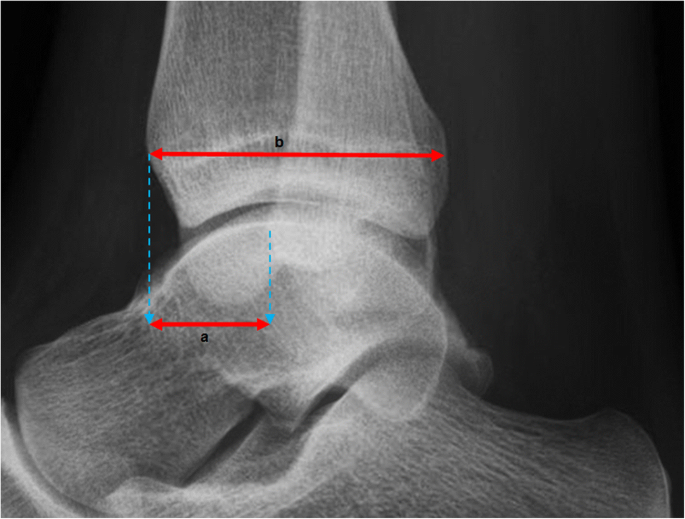 What is Chronic Ankle Instability?: Eugene Stautberg, MD: General