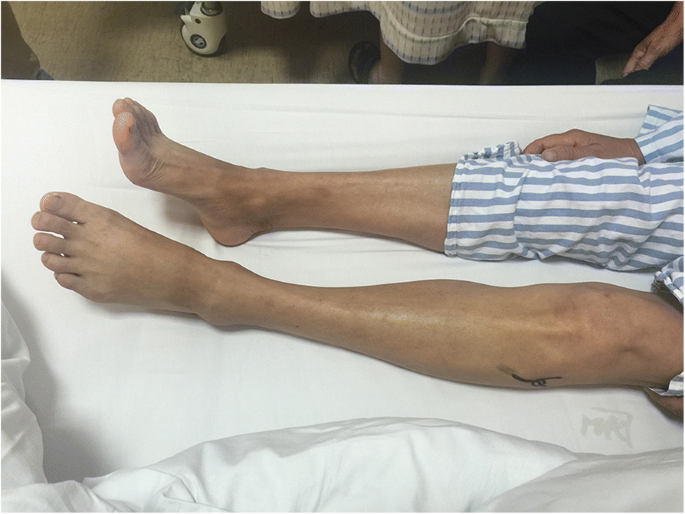 A rapidly progressive foot drop caused by the posttraumatic