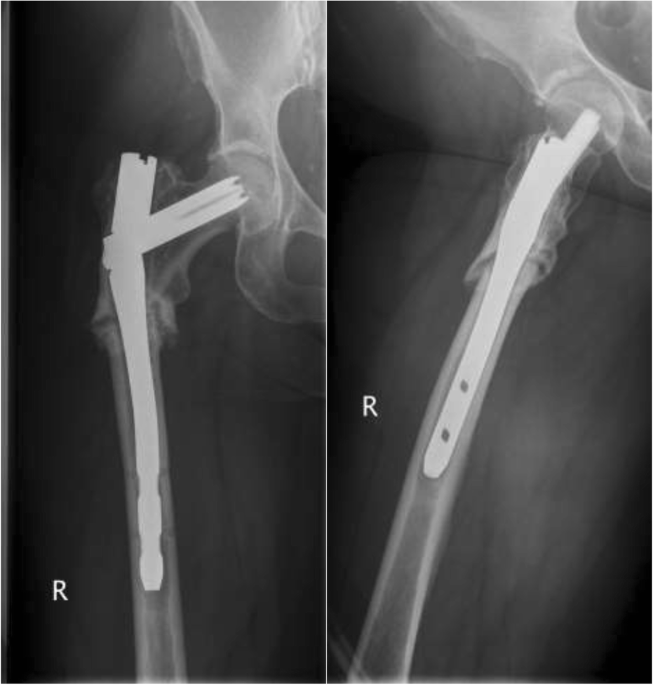 Comparing outcomes of plate augmentation, nail exchange, and nail exchange  with plate augmentation in the treatment of atrophic femoral shaft nonunion  after intramedullary nailing: a multicenter retrospective study | Archives  of Orthopaedic
