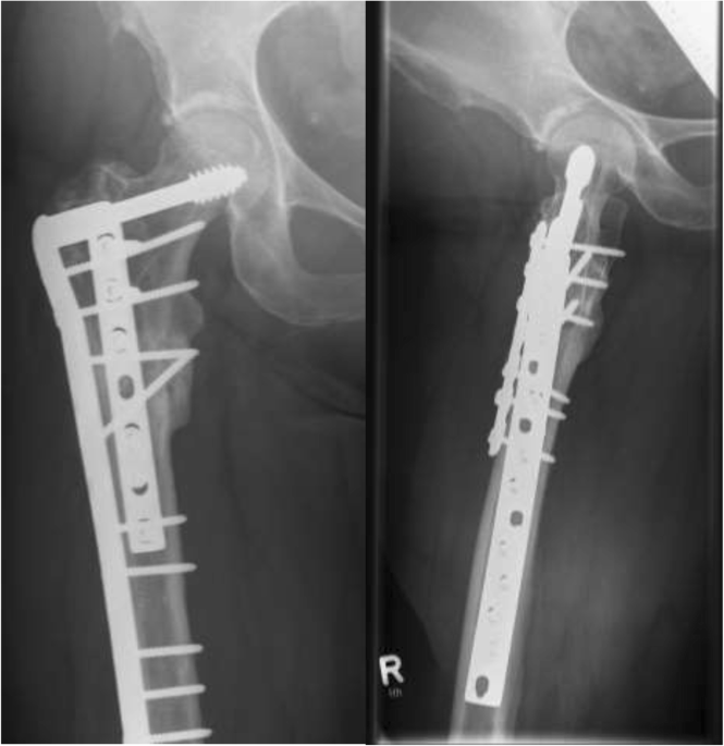 MedShape Announces Commercial Launch of the DynaClip Forte® NiTiNOL Bone  Fixation System - Ortho Spine News