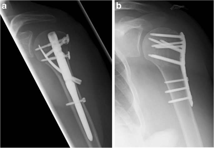 Telegraph nail used for internal fixation of proximal humerus fracture |  European Journal of Orthopaedic Surgery & Traumatology