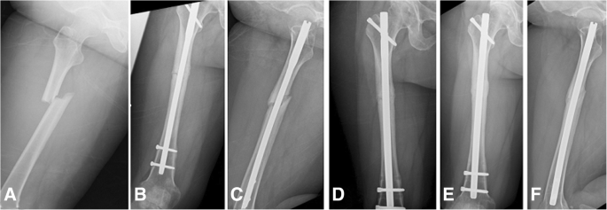 For intramedullary nailing of femoral shaft fractures, talon fixation is  helpful to cope with the troublesome distal locking, bu