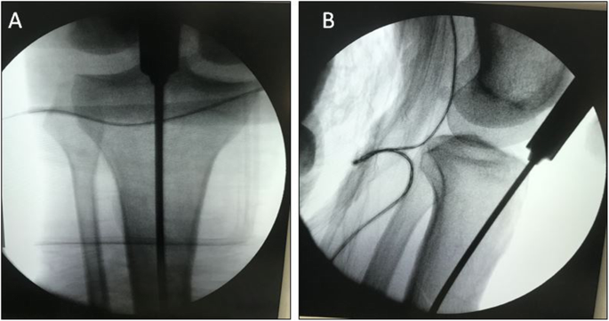 Nail insertion points in semi-extended nailing of tibial fractures and  their influence on alignment: A retrospective cohort stud