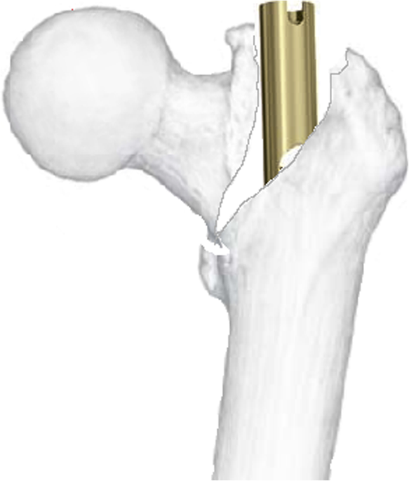 Inverse relationship between femoral lateralization and neck-shaft angle is  a joint event after intramedullary nailing of per trochanteric fractures |  Scientific Reports