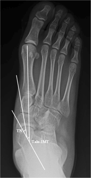 Discrepancy between true ankle dorsiflexion and gait kinematics