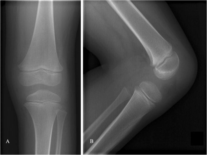 Magnetically Expandable Prosthesis: Preserving Limb Length in Pediatric Ewing Sarcoma