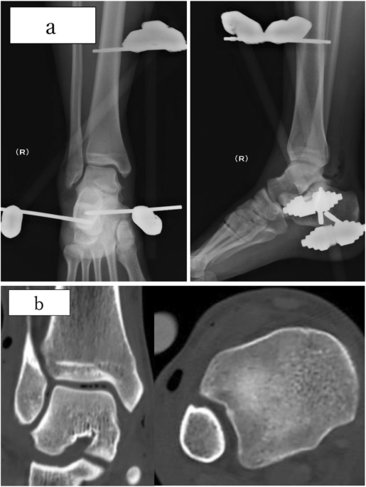Treatment of open ankle dislocation without associated fractures in a young  athlete using external fixation and ligament repair with suture tape  augmentation | BMC Musculoskeletal Disorders | Full Text