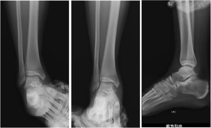 A practical treatise on fractures and dislocations . g lost its