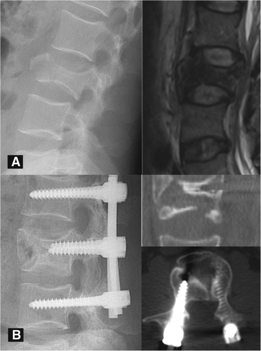 Healing pattern classification for thoracolumbar burst fractures after  posterior short-segment fixation | BMC Musculoskeletal Disorders | Full Text