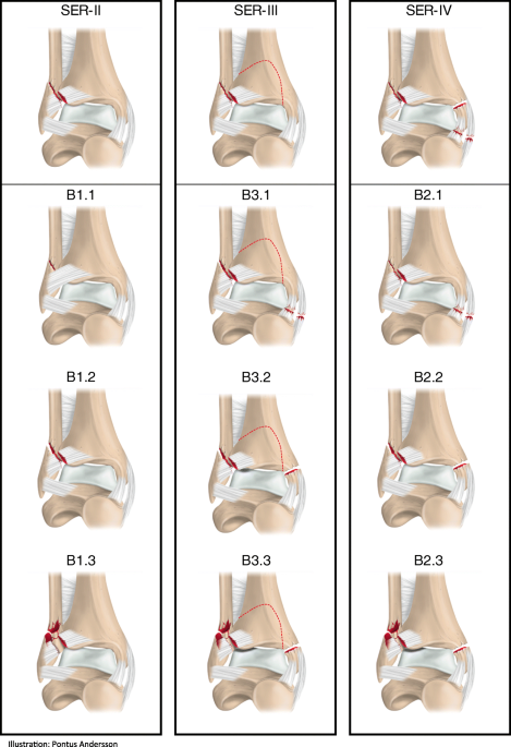 Classification and treatment of lateral malleolar fractures - a  single-center analysis of 439 ankle fractures using the Swedish Fracture  Register, BMC Musculoskeletal Disorders