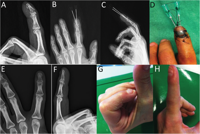 K-wire fixation vs 23-gauge percutaneous hand- crossed hypodermic needle  for the treatment of distal phalangeal fractures | BMC Musculoskeletal  Disorders | Full Text