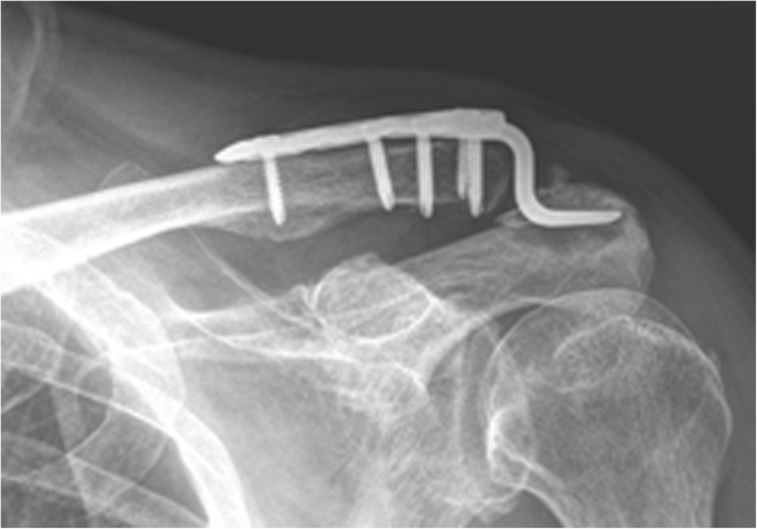 Hook plate with or without coracoclavicular ligament augmentation in the  treatment of acute acromioclavicular separation, BMC Musculoskeletal  Disorders