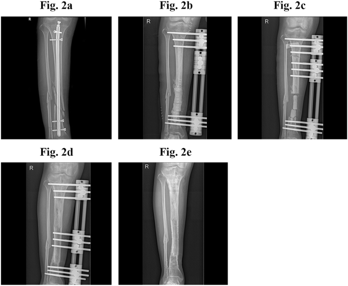 A, Injury radiographs of a tibia fracture. B, Postoperative image of... |  Download Scientific Diagram