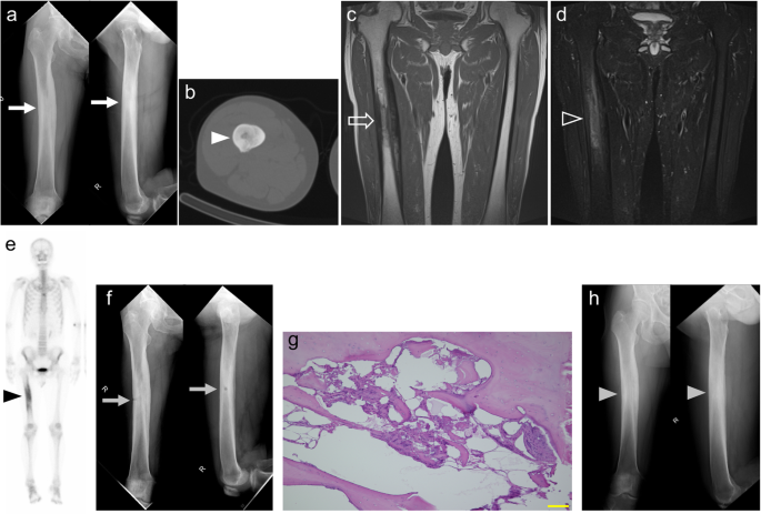 Diagnosis and treatment of intramedullary osteosclerosis: a report of three  cases and literature review | BMC Musculoskeletal Disorders | Full Text