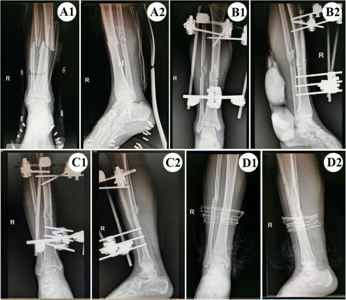 Ring external fixator (definitive) for Complete articular fracture