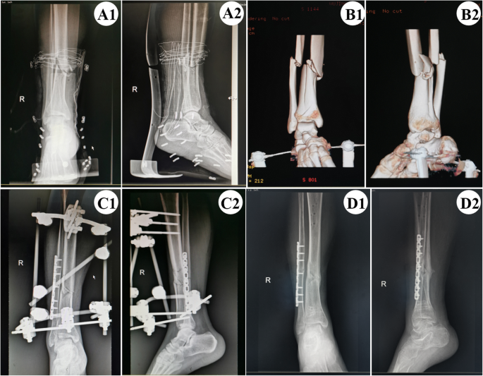 Orthopedic Instrument Trauma Tibial External Fixator System for Tibia  Fracture - China Synth External Fixation, External Fixator