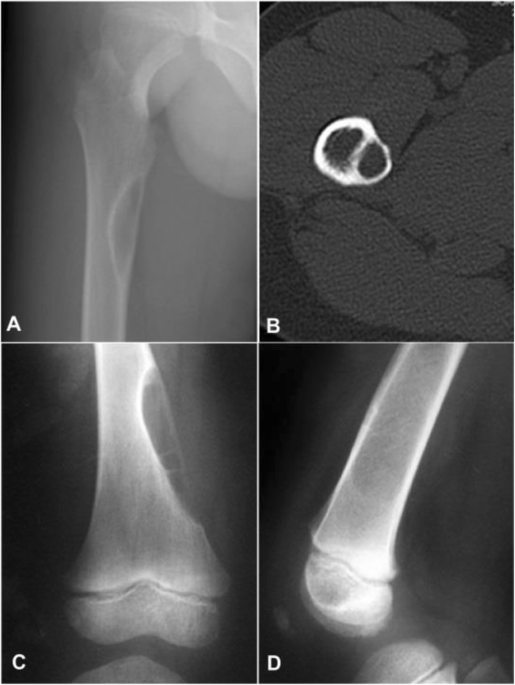 Lateral radiograph of the left tibia demonstrating the characteristic