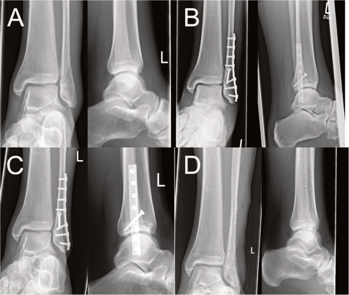 Is early full weight bearing safe following locking plate ORIF of distal  fibula fractures? | BMC Musculoskeletal Disorders | Full Text