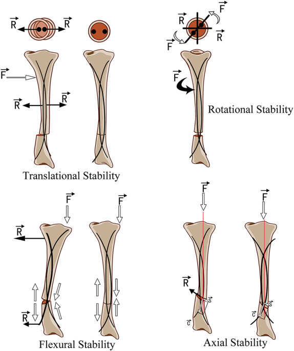 AAOS OVT - Semiextended Tibial Nailing Using the Modified Medial Arthrotomy