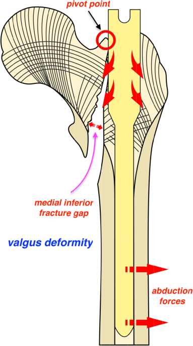 Femur Fracture Fixation with Intramedullary Rod - Orthoriverside.com
