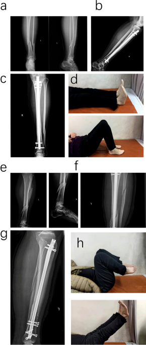 Cureus | Intramedullary Nailing of Concurrent Bilateral Tibial Stress  Fractures Followed by Unilateral Tension Plating for a Nonunion in a  Vitamin D-Deficient Elite Football Player