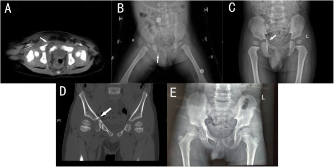 Retrospective analysis of traumatic triradiate cartilage injury in children  | BMC Musculoskeletal Disorders | Full Text