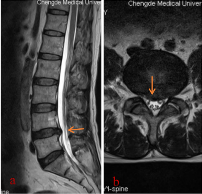 The diagnostic pitfalls of lumbar disc herniation---- malignant sciatic  nerve tumour: two case reports and literature review, BMC Musculoskeletal  Disorders