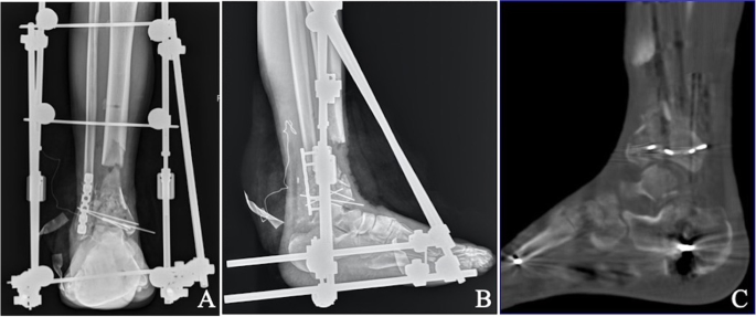 Analysis of bone transport for ankle arthrodesis as a limb salvage  procedure for the treatment of septic pilon fracture nonunion