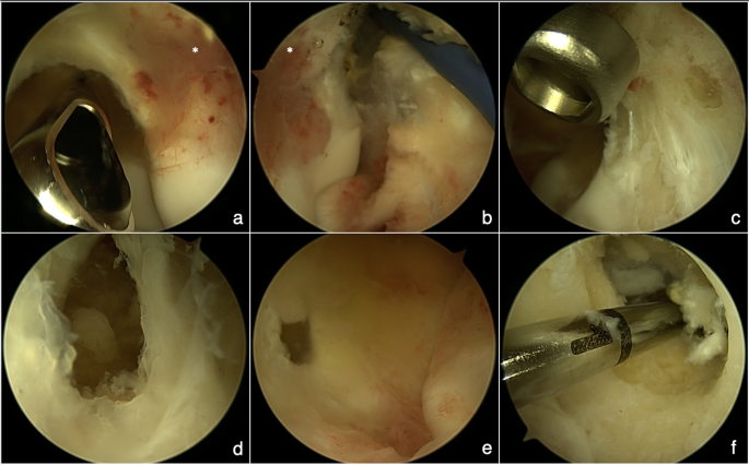Table 1 from Alternative Treatment of Osteoma Using an Endoscopic  Holmium-YAG Laser
