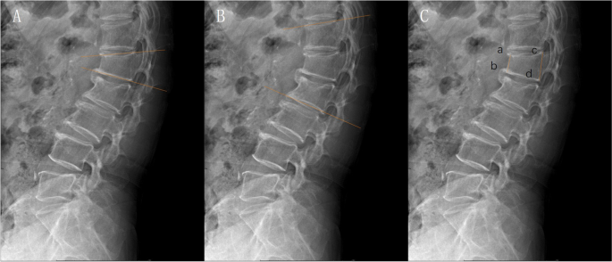 Acute osteoporotic compression fracture - L5